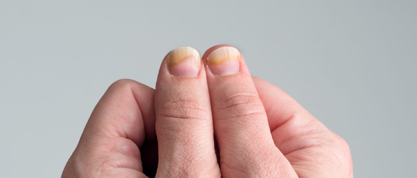 Nagelpilz behandeln  Ursachen, Anzeichen & Therapie